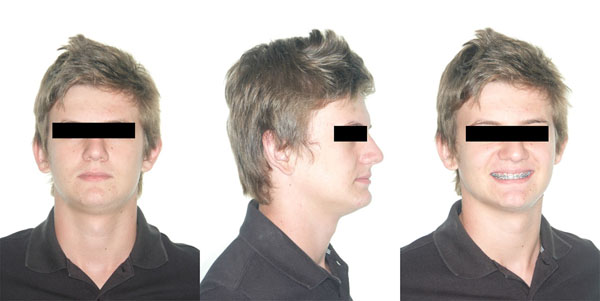 Prevalence of the Short Face Pattern in Individuals of Bauru-Brazil