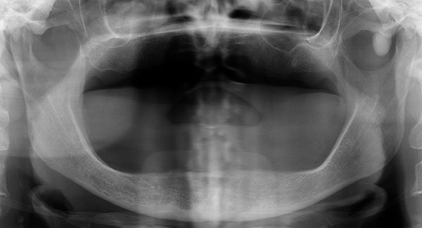 Peripheral Solitary Osteoma of the Zygomatic Arch: A Case Report and Literature Review
