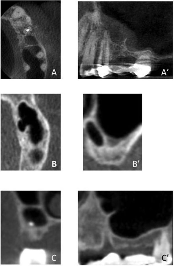 Complications During Maxillary Sinus Augmentation Associated with Interfering Septa: A New Classification of Septa