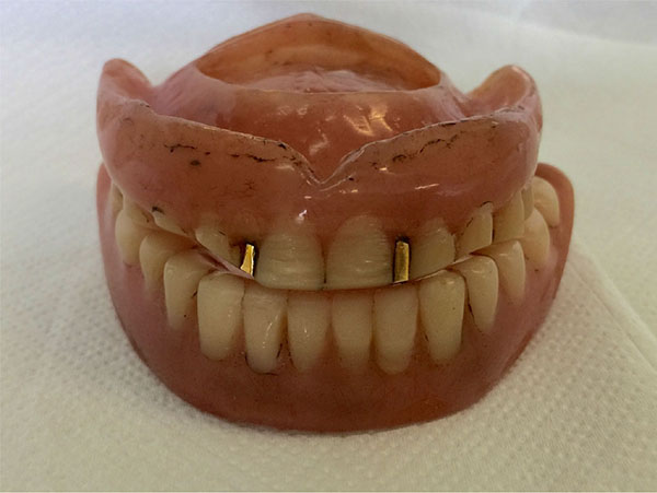 A 5-week Non-Surgical Approach towards Denture Induced Hyperplasia