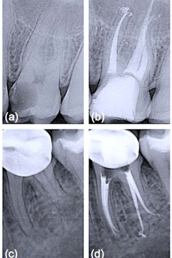 Bioactive-glass in Endodontic Therapy and Associated Microsurgery