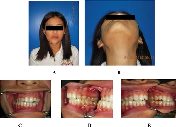 Dentofacial Deformity Caused by Bulky Osteochondroma: Report of an Unusual Case and the Importance of Cone Beam Computed Tomography