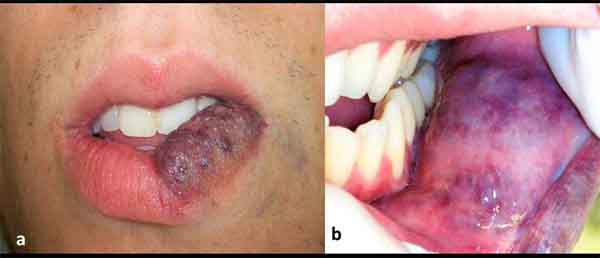Management of an Extensive Vascular Lesion on the Lip by Photocoagulation with High-Intensity Diode Laser