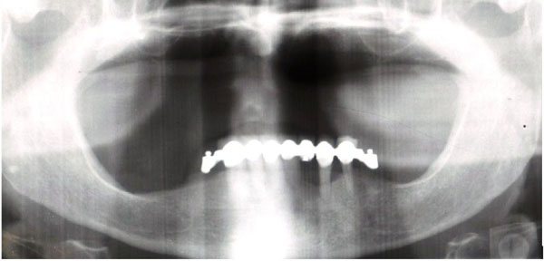 Maxillary Overdenture Retained with an Implant Support CAD-CAM Bar: A 4 Years Follow Up Case