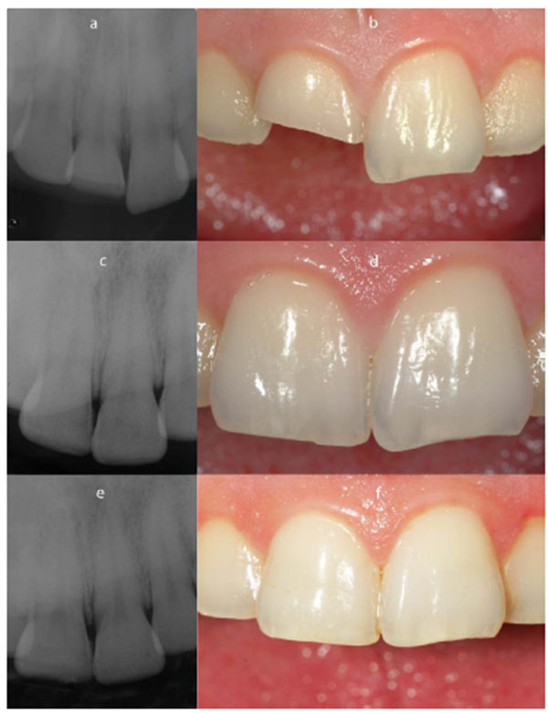 The Coronal Tooth Fractures: Preliminary Evaluation of a Three-Year Follow-Up of the Anterior Teeth Direct Fragment Reattachment Technique Without Additional Preparation