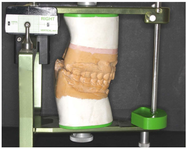 Efficacy of Selective Grinding Guided by an Occlusal Splint in Management of Myofascial Pain: A Prospective Clinical Trial