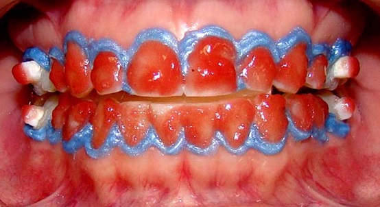 Chemical Composition and Microhardness of Human Enamel Treated with Fluoridated Whintening Agents. A Study 