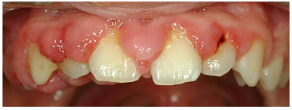 On the Cellular and Molecular Mechanisms of Drug-Induced Gingival Overgrowth