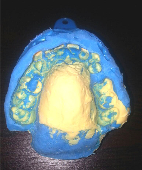 Prosthodontic Rehabilitation of Arabic Speaking Individuals with Velopharyngeal Incompetence: A Preliminary Study