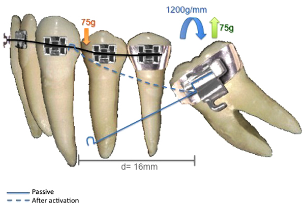 Molar Uprighting: A Considerable and Safe Decision to Avoid Prosthetic Treatment