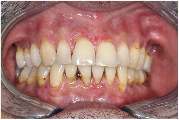 Oral Leiomyoma in an Adult Male: A Case Report