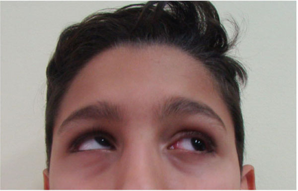 Facial and Orbital Fractures: A Fifteen Years Retrospective Evaluation of North East Sicily Treated Patients