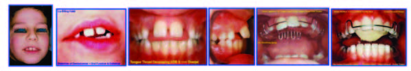 Orthodontic Treatment Timing and Modalities in Anterior Open Bite: Case Series Study