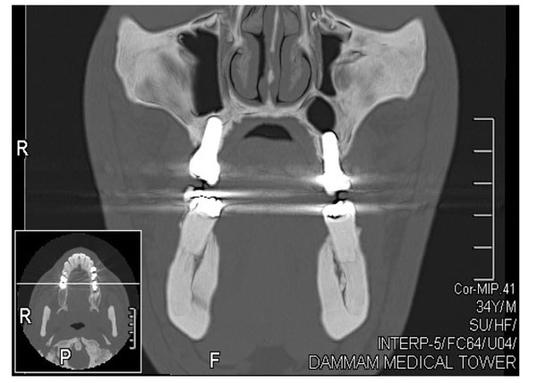 A Split-Mouth Design Comparison for Lateral and Crestal Sinus Lift Techniques with Dental Implants Placements: Short Communication