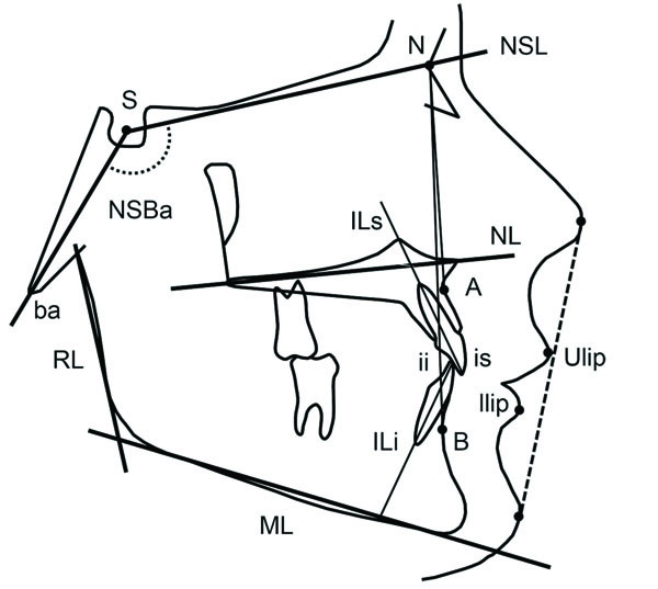 Anterior Bite Opening in Adulthood