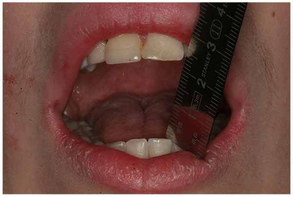 Bilateral Elongated Mandibular Coronoid Process and Restricted Mouth Opening: A Case Report