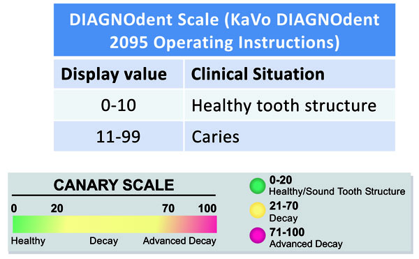 Correlation with Caries Lesion Depth of The Canary System, DIAGNOdent and ICDAS II