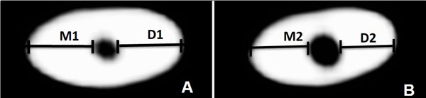 Root Canal Transportation and Centering Ability of Nickel-Titanium Rotary Instruments in Mandibular Premolars Assessed Using Cone-Beam Computed Tomography