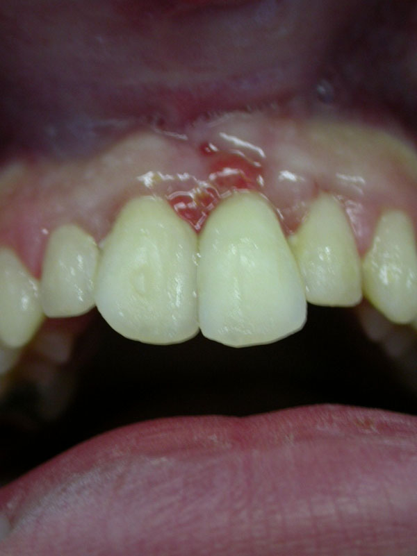 Alveolar Bone Fracture: Pathognomonic Sign for Clinical Diagnosis