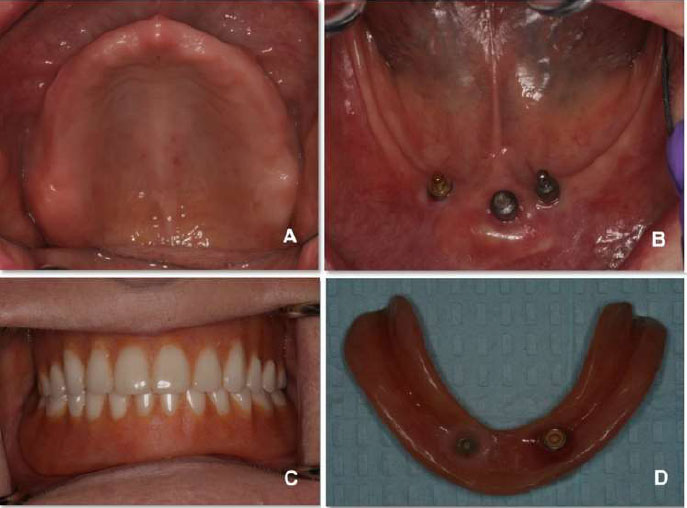 Implant-supported Overdenture Using CAD/CAM Milled Bar and Locator Attachments: A Technical and Case Report