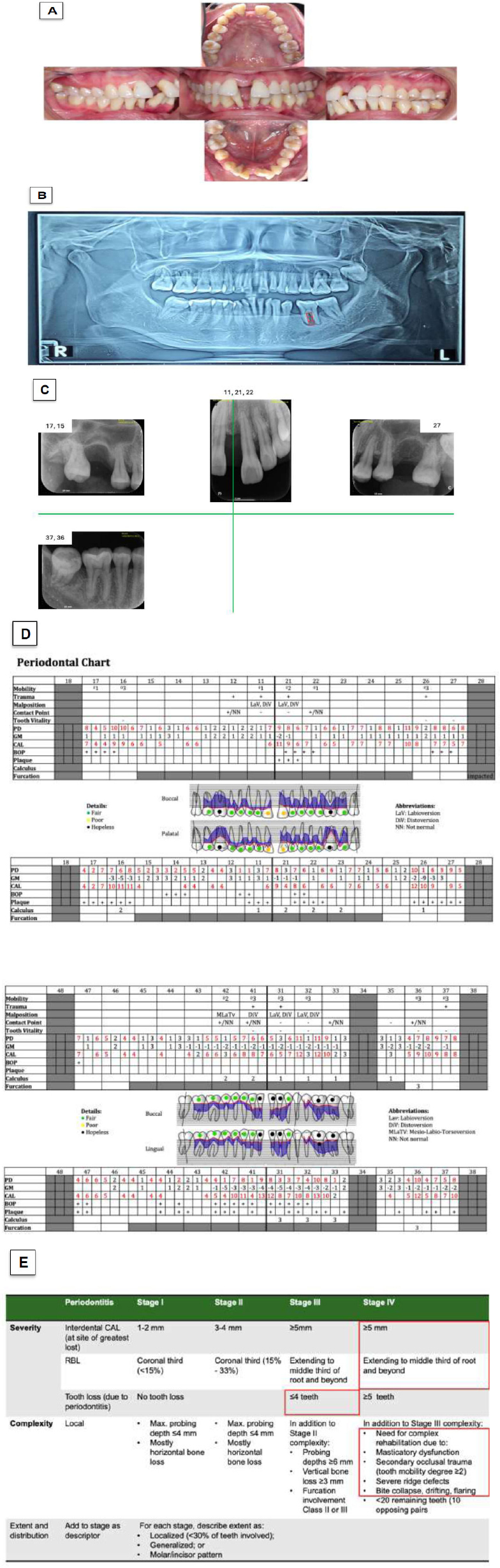 Clinical Phenotypes of Stage IV Grade C Periodontitis in the Absence of Grade Modifiers: Case Reports