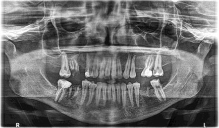 Uncommon Inferior Alveolar Nerve Injury Associated with the Mandibular Second Molar: A Case Report