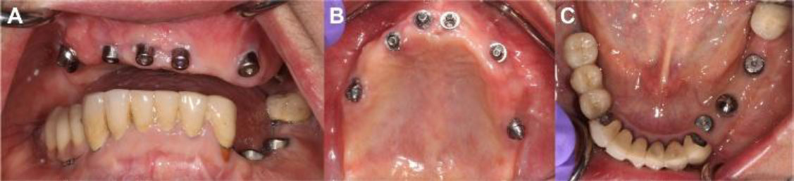 Management of Severely Angulated Implants using Both Angled Abutments and Mesostructures: A Clinical Report