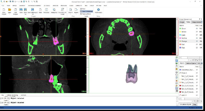 Age Estimation using Pulp Chamber/Crown Volume Ratio of Permanent Maxillary and Mandibular Second Molars