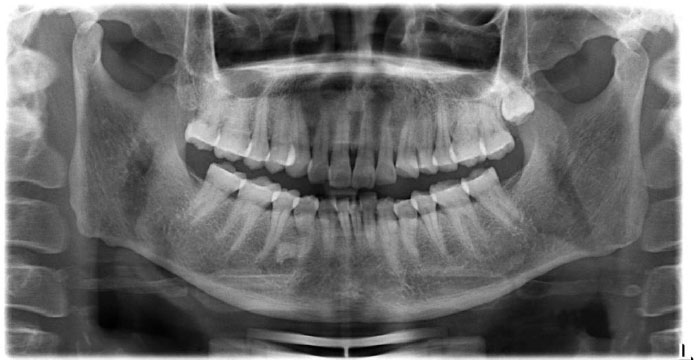 Utilizing Artificial Intelligence to Diagnose Temporomandibular Joint Osteoarthritis  Orthopantomographs