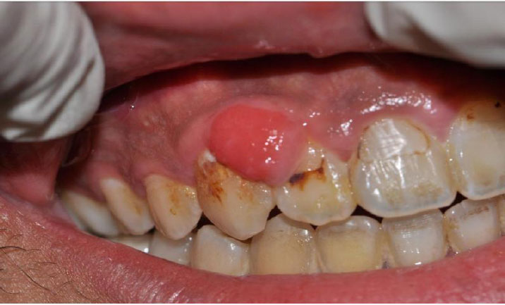 Gingival Overgrowth in an E-Cigarette User: A Case Report of a Possible Association