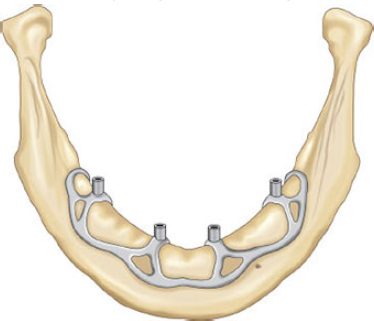 Customized Subperiosteal Dental Implants: A State-of-the-Art Narrative Review