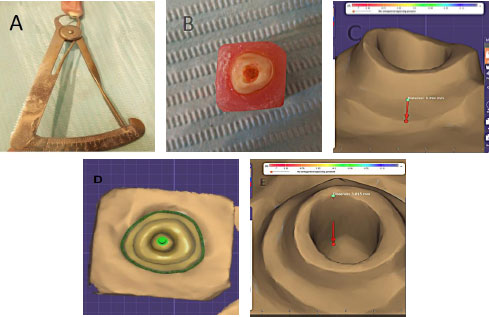 Failure Patterns of Severely Compromised Endodontically Treated Anterior Teeth: A Comparative  Study of Two Restorative Approaches