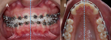 Comparative Evaluation of Root Resorption in First Upper Premolars Treated with Active and Passive Self-ligating Brackets: A Prospective Split-mouth Study