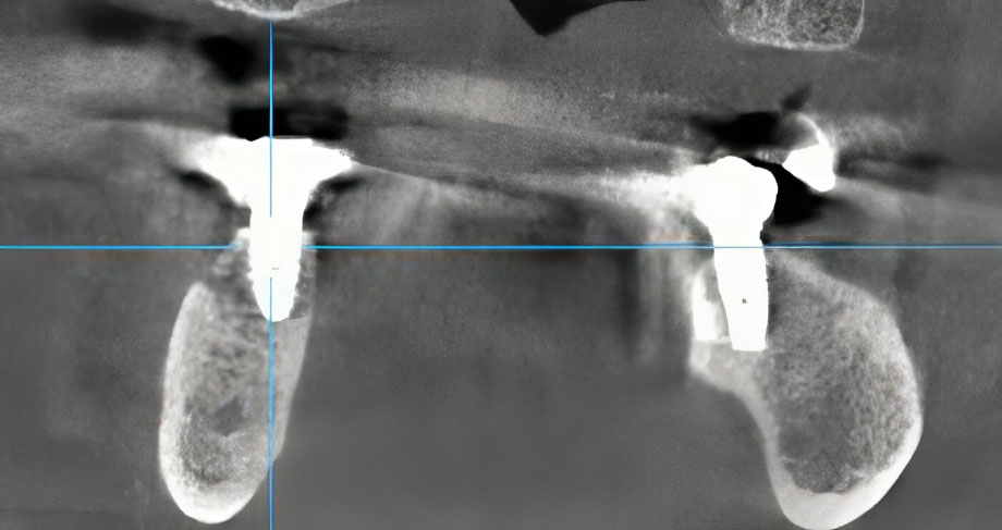 Medication-related Osteonecrosis of the Jaw and Dental Implant: A Case Report
