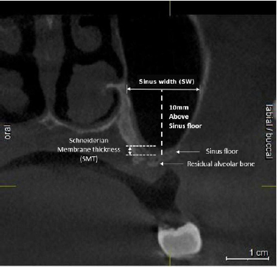 Associations of Sinus Width, Septa, and Schneiderian Membrane Thickness with Bone Formation After Lateral Window Sinus Augmentation