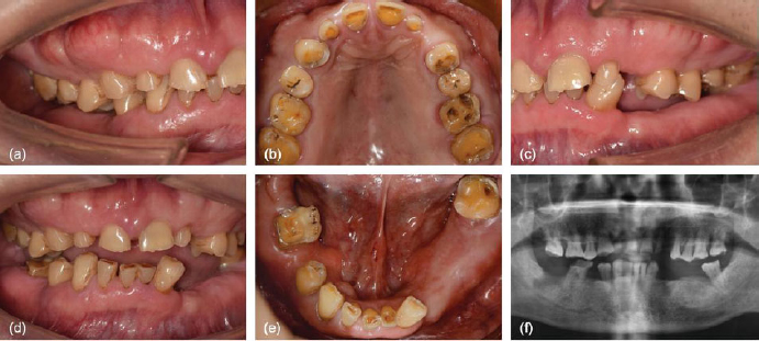 4D Digital Kinematic Workflow for the Full-mouth Rehabilitation of Severe Tooth Wear: A 5-Year Case Report