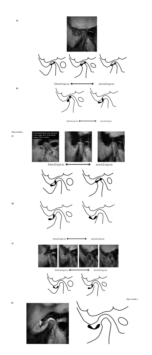 Analysis of Magnetic Resonance Images of Disk Positions and Deformities in 1,265 Patients with Temporomandibular Disorder