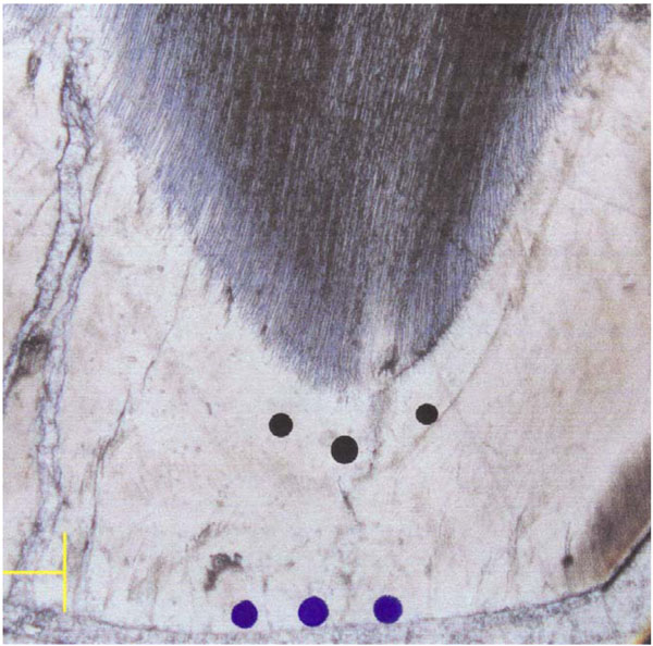 Acid Resistance of the Enamel in Primary Second Molars from Children with Down Syndrome and Cerebral Palsy