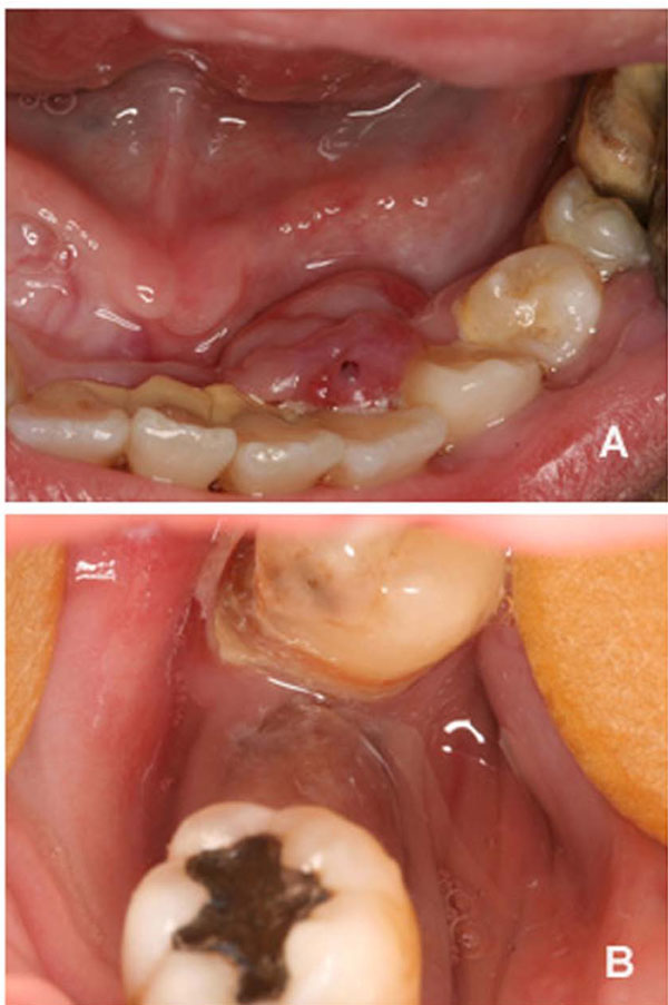 Oral Giant Cell Granuloma in a Patient with Glycogen Storage Disease