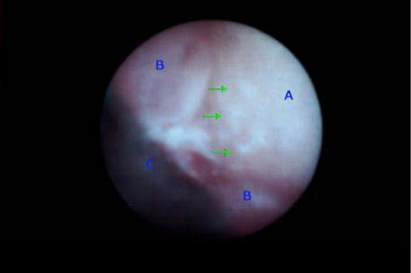The Relationship Between Bleeding on Probing and Subgingival Deposits. An Endoscopical Evaluation