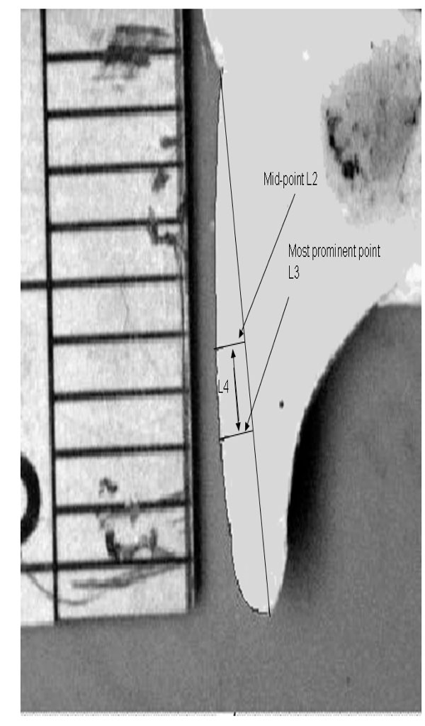 The Relationship Between the Mid-Point and Most-Prominent Point on the Labial Curve of Upper Anterior Teeth