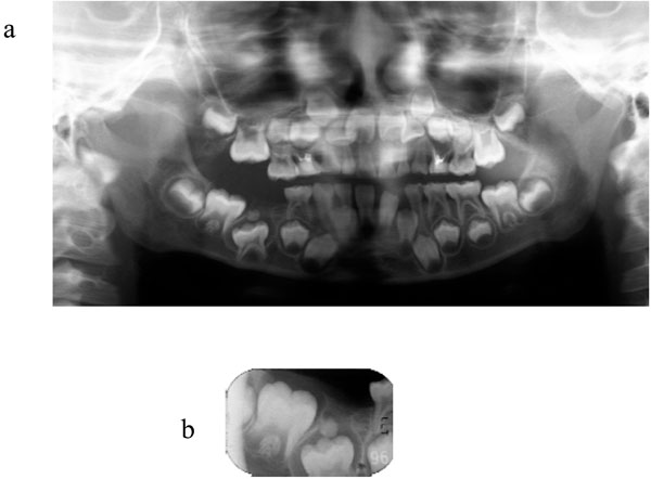 A Case of Unerupted Lower Primary Second Molar Associated with Compound Odontoma