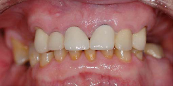 A Treatment Protocol for Restoring Occlusal Vertical Dimension Using an Overlay Removable Partial Denture as an Alternative to Extensive Fixed Restorations: A Clinical Report