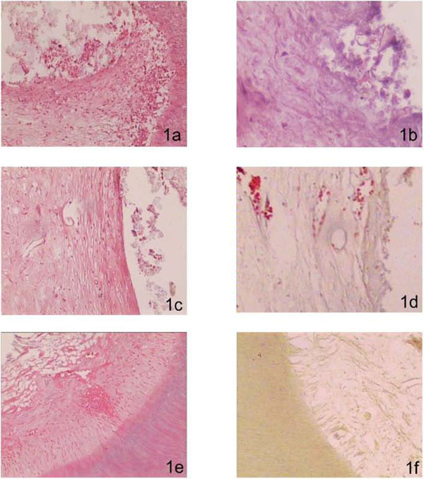 Short-Term Analysis of Human Dental Pulps After Direct Capping with Portland Cement