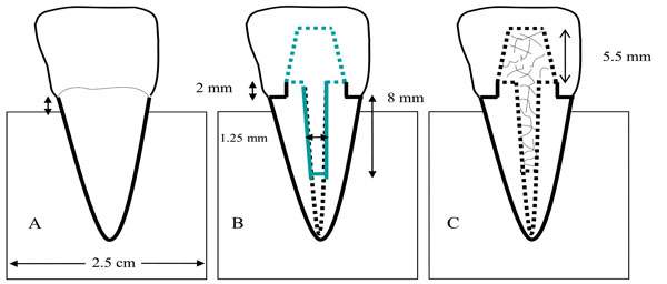 Continuous and Short Fiber Reinforced Composite in Root Post-Core System of Severely Damaged Incisors