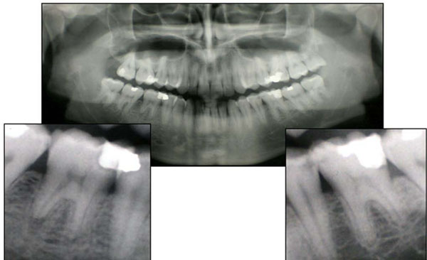 Extrusion of Endodontic Filling Materials: Medico-Legal Aspects. Two Cases