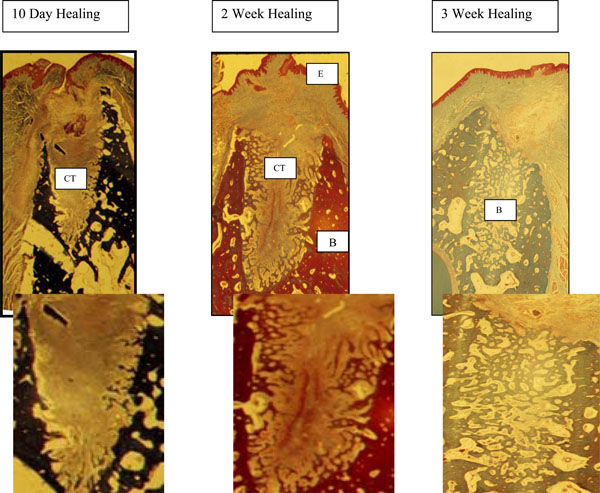 Clinical and Histological Comparison of Extraction Socket Healing Following the Use of Autologous Platelet-Rich Fibrin Matrix (PRFM) to Ridge Preservation Procedures Employing Demineralized Freeze Dried Bone Allograft Material and Membrane