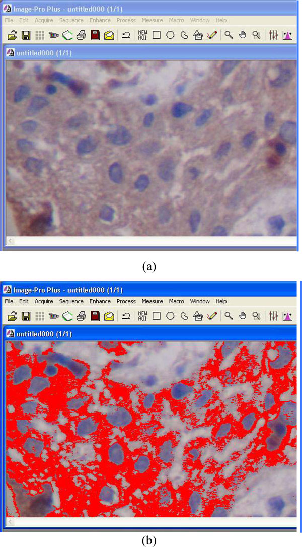 Notch 1 Receptor, Delta 1 Ligand and HES 1 Transcription Factor are  Expressed in the Lining Epithelium of Periapical Cysts (Preliminary Study)
