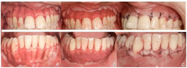 Corticotomy-Assisted Orthodontic Treatment: Review
