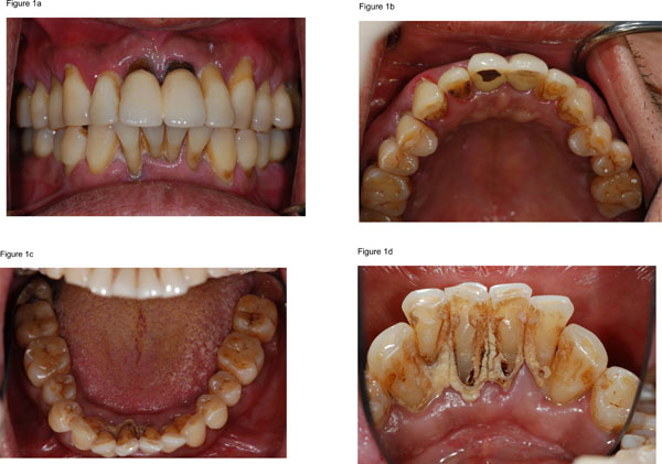 Full Mouth Rehabilitation with Implant-Supported Prostheses for Severe Periodontitis: A Case Report 